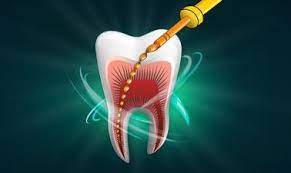 Root Canal