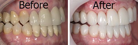 full mouth rehabilitation