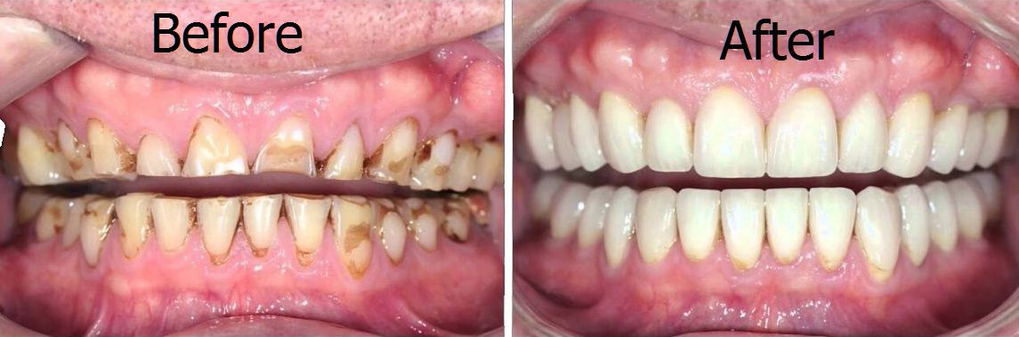 full mouth rehabilitation