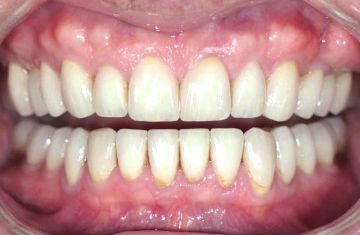 full mouth rehabilitation
