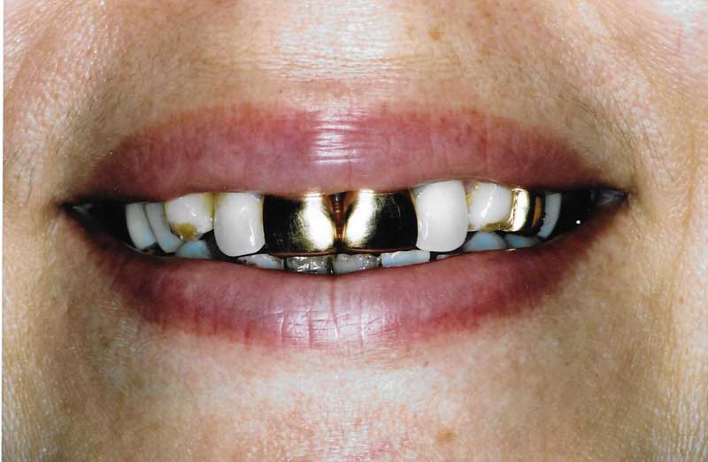 full mouth rehabilitation