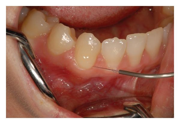 Hypersensitivity Relief