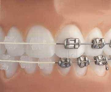 Orthodontic