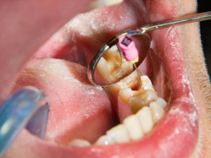 root canal